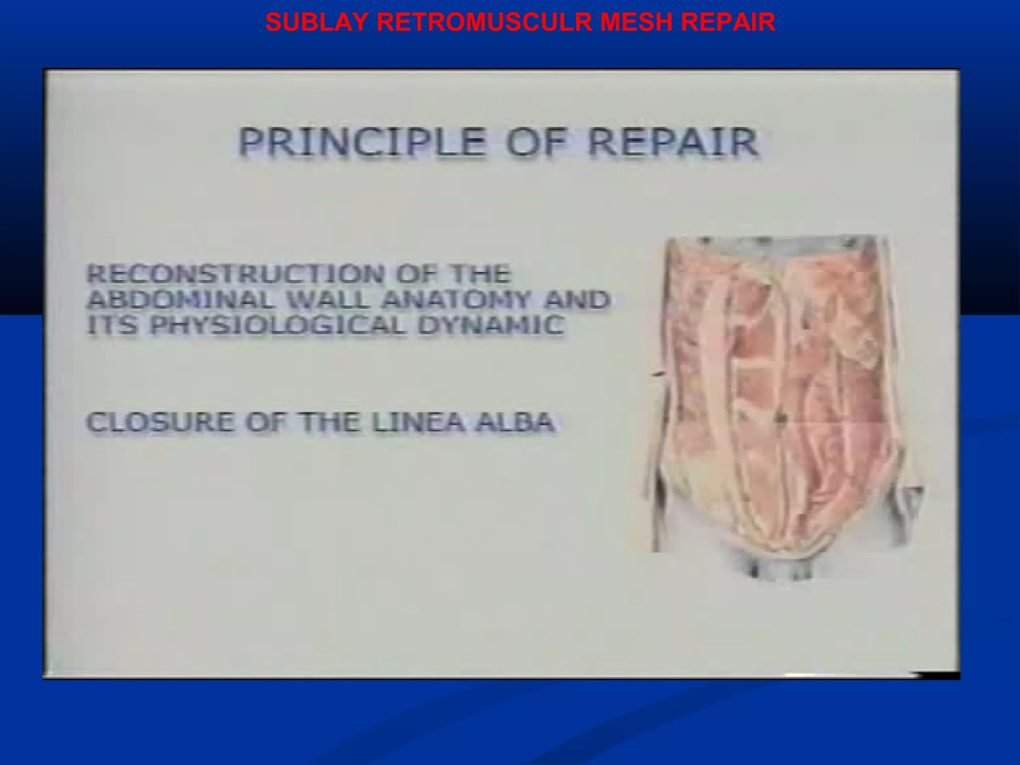 SUBLAY RETROMUSCULR MESH REPAIR
 