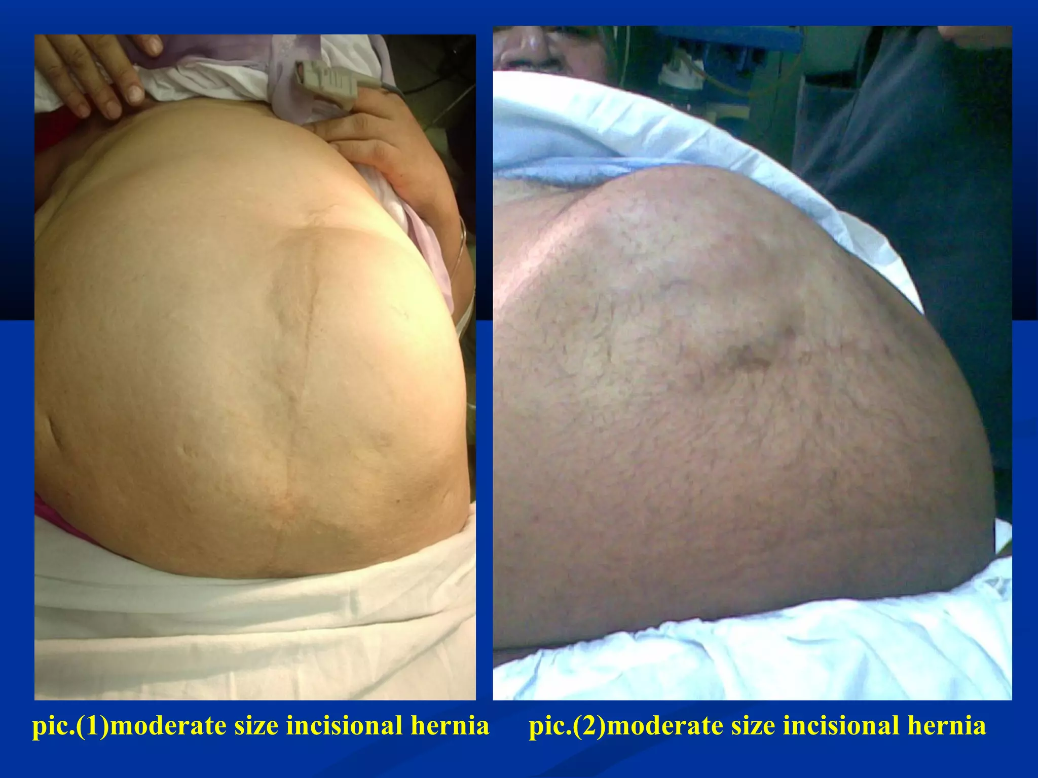 pic.(2)moderate size incisional herniapic.(1)moderate size incisional hernia
 