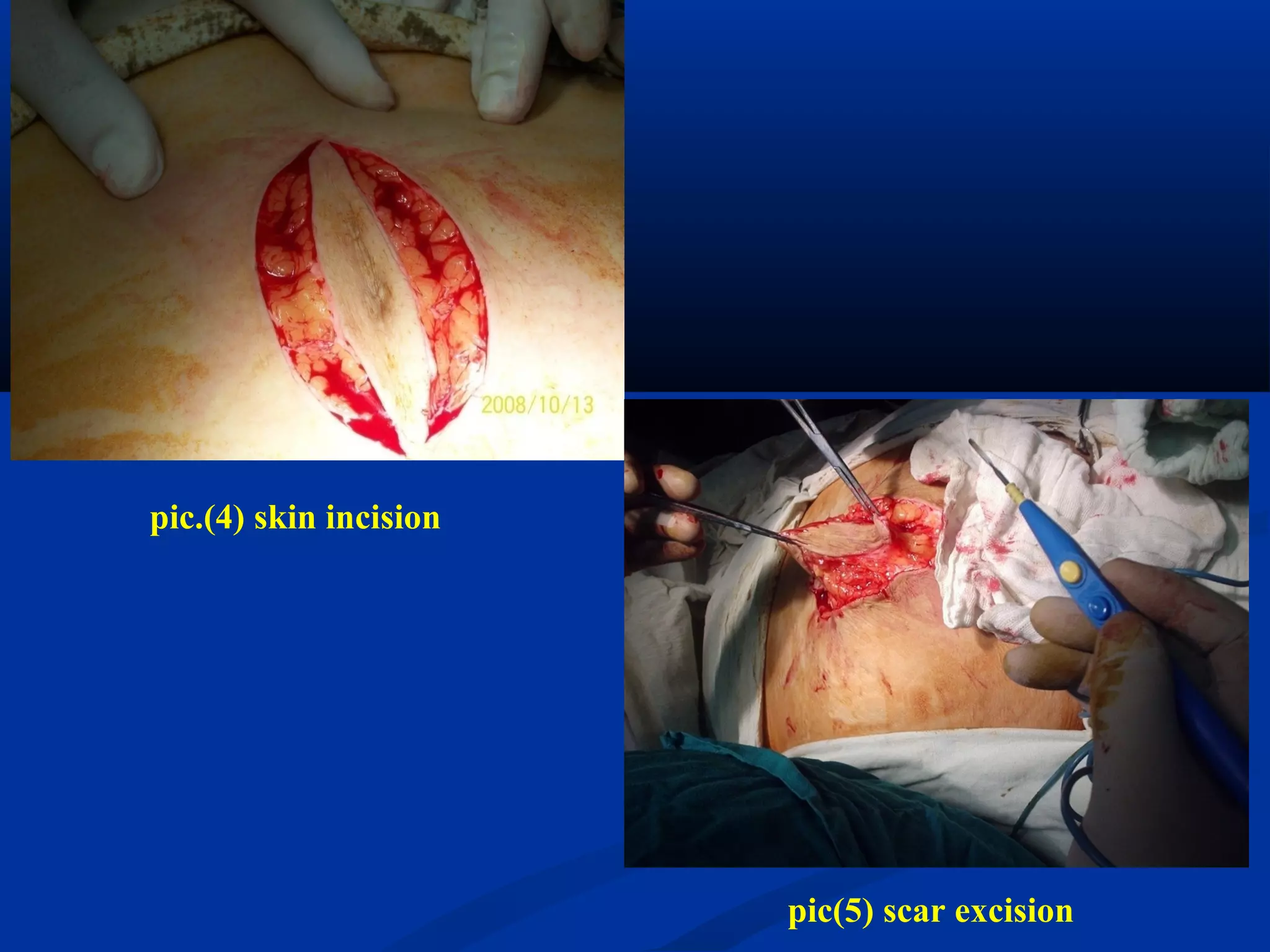pic.(4) skin incision
pic(5) scar excision
 