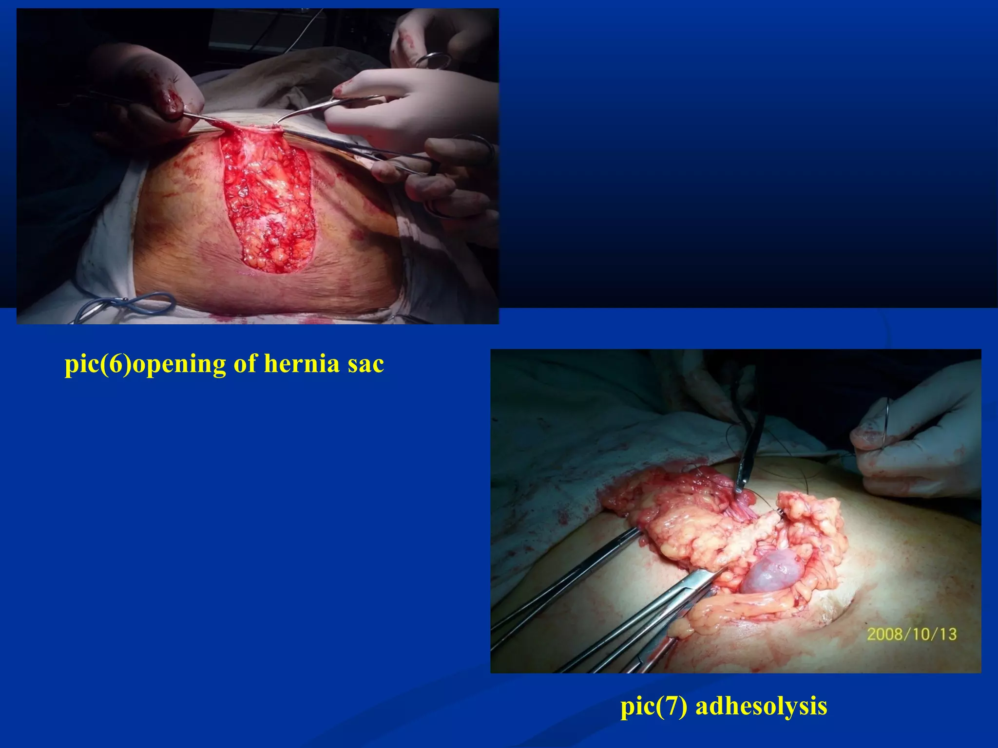 pic(6)opening of hernia sac
pic(7) adhesolysis
 