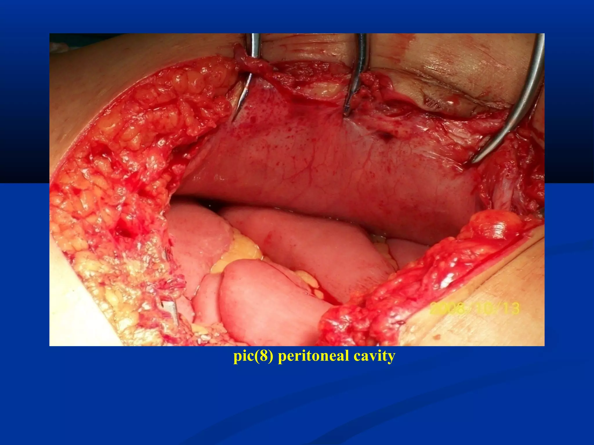pic(8) peritoneal cavity
 