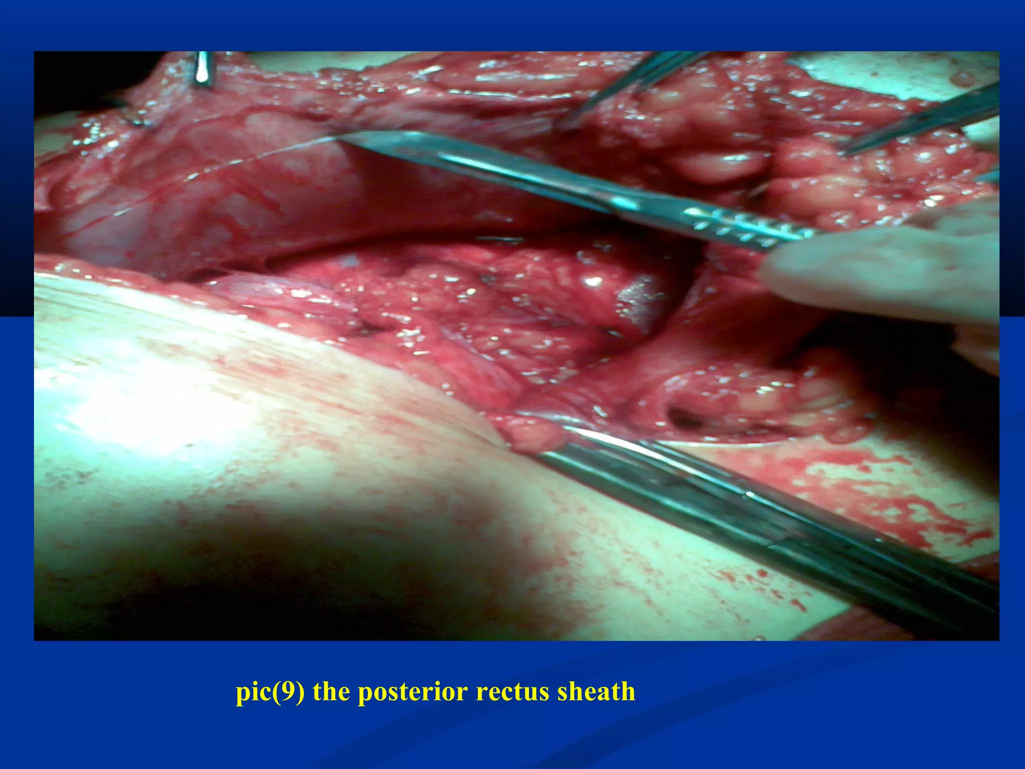 pic(9) the posterior rectus sheath
 