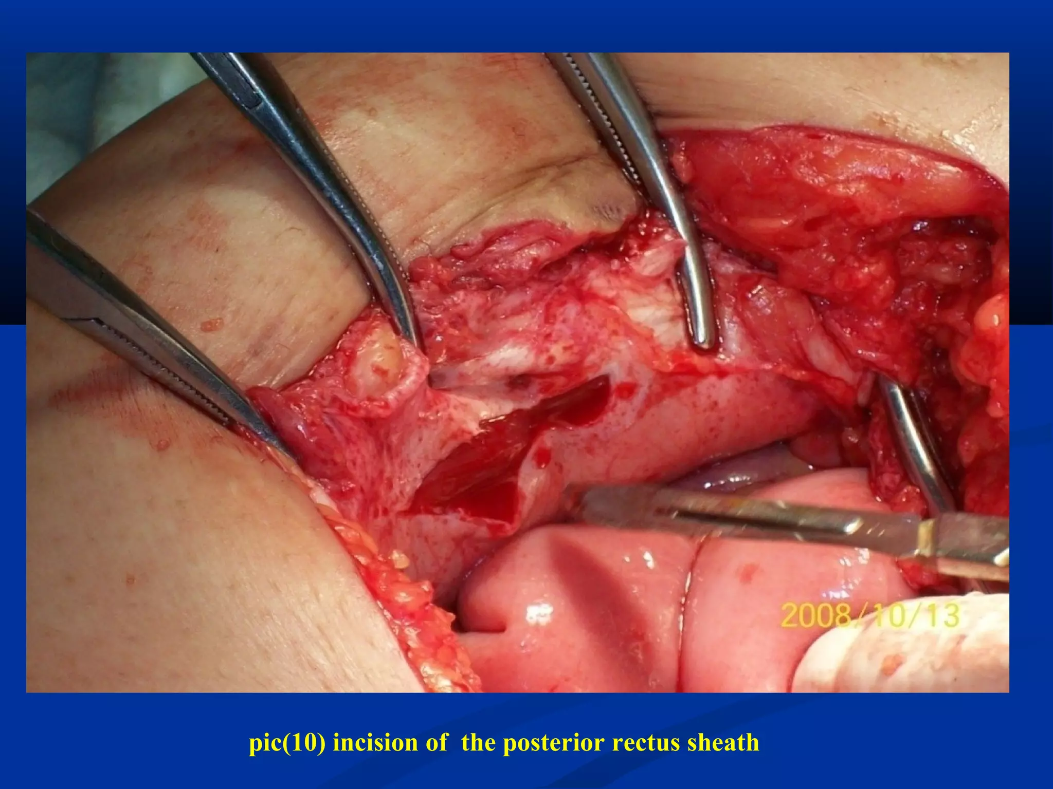 pic(10) incision of the posterior rectus sheath
 