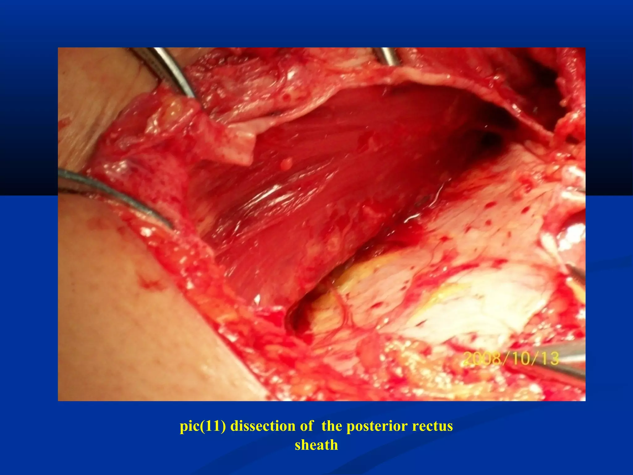 pic(11) dissection of the posterior rectus
sheath
 