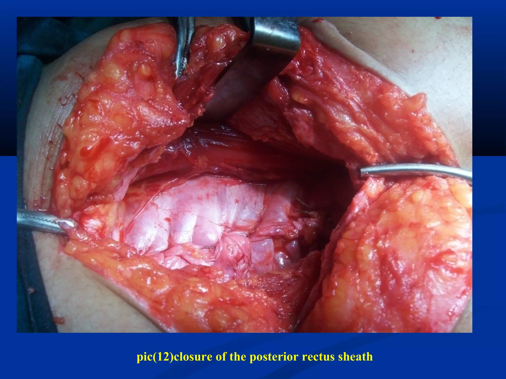 pic(12)closure of the posterior rectus sheath
 