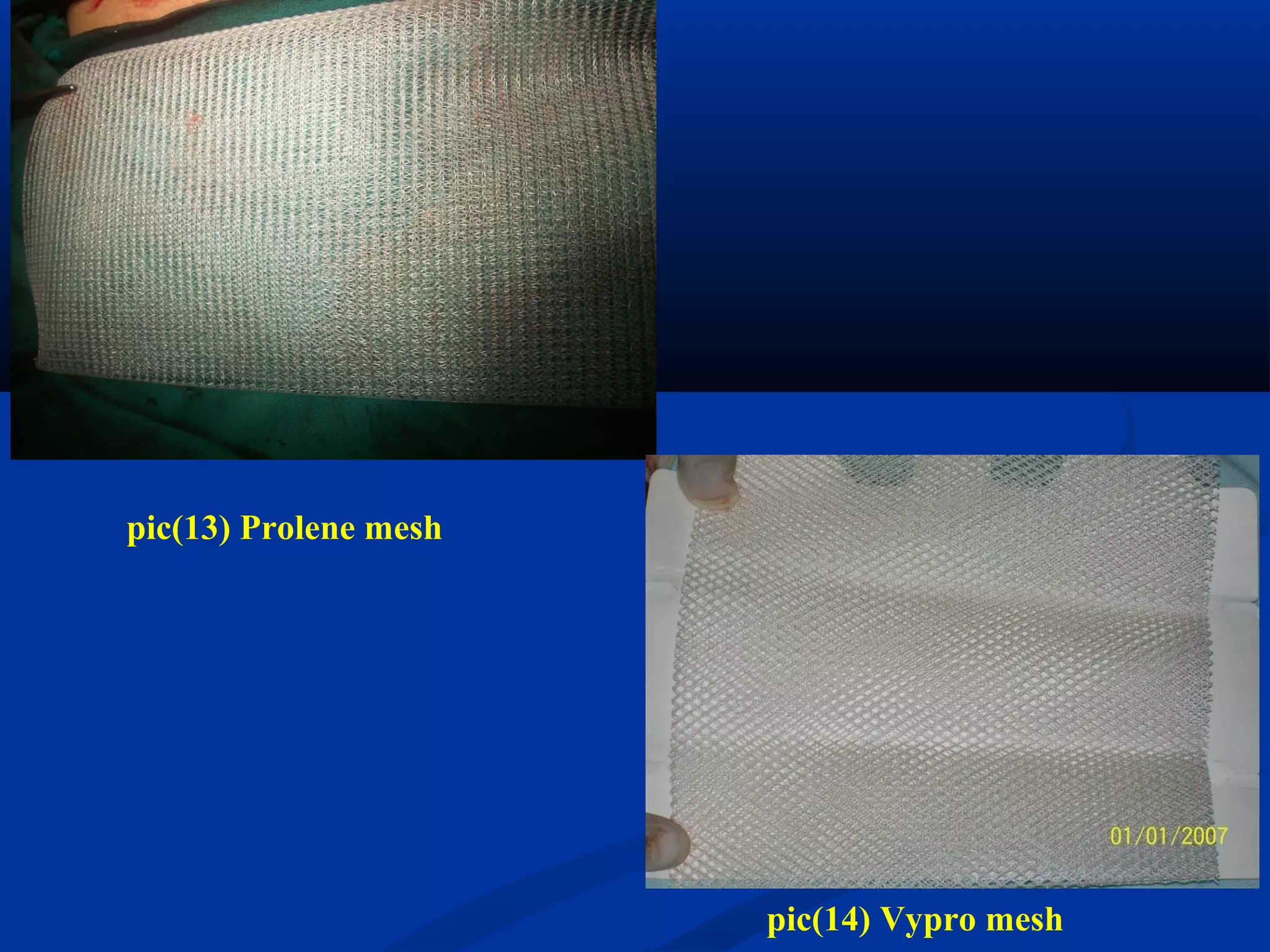 pic(13) Prolene mesh
pic(14) Vypro mesh
 
