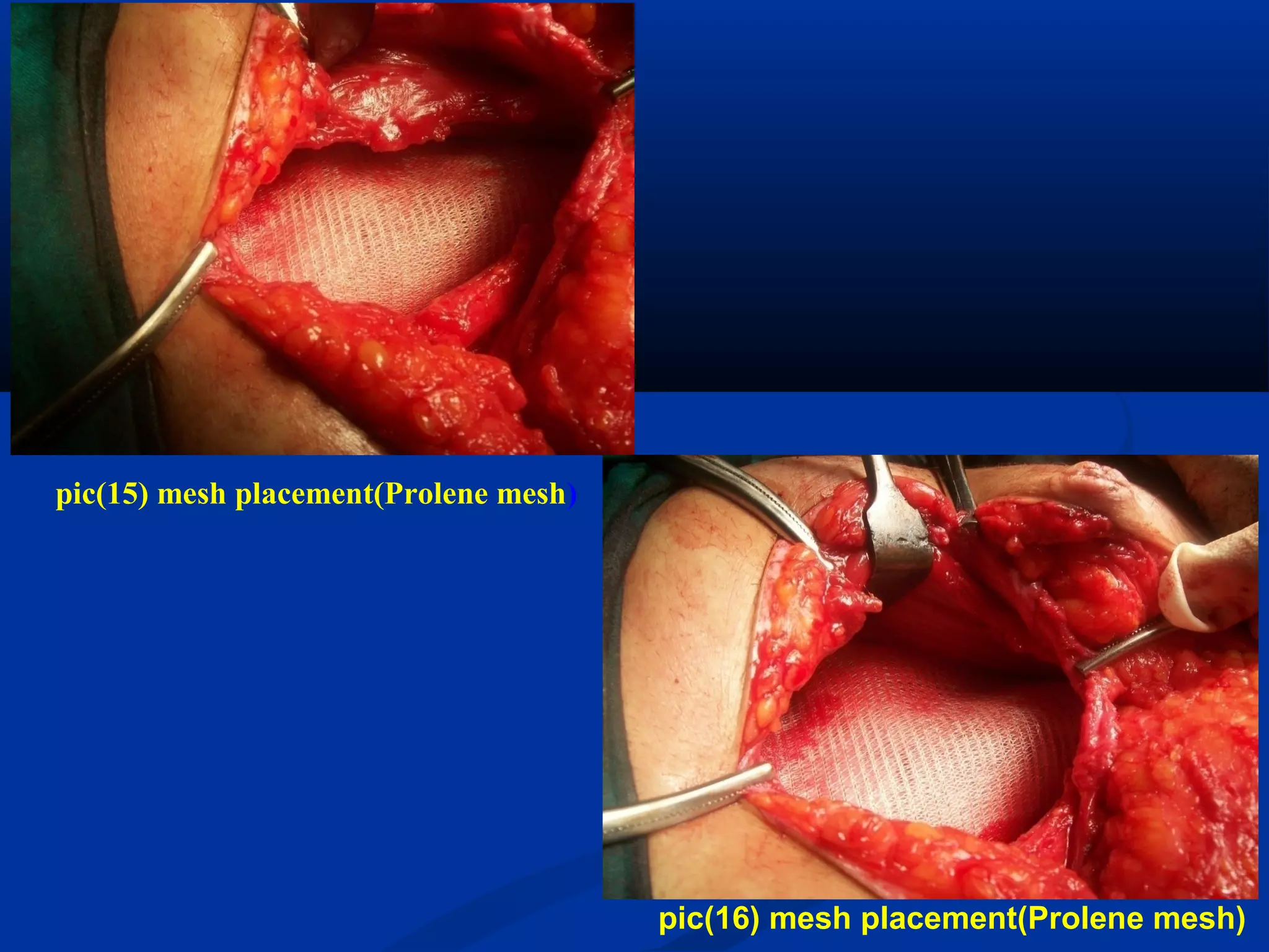 pic(15) mesh placement(Prolene mesh)
pic(16) mesh placement(Prolene mesh)
 