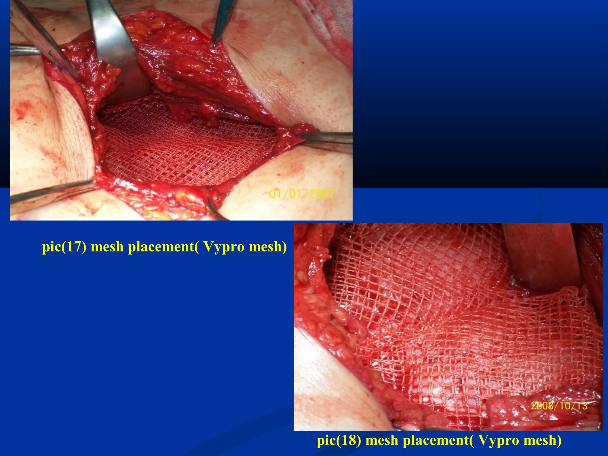 pic(17) mesh placement( Vypro mesh)
pic(18) mesh placement( Vypro mesh)
 