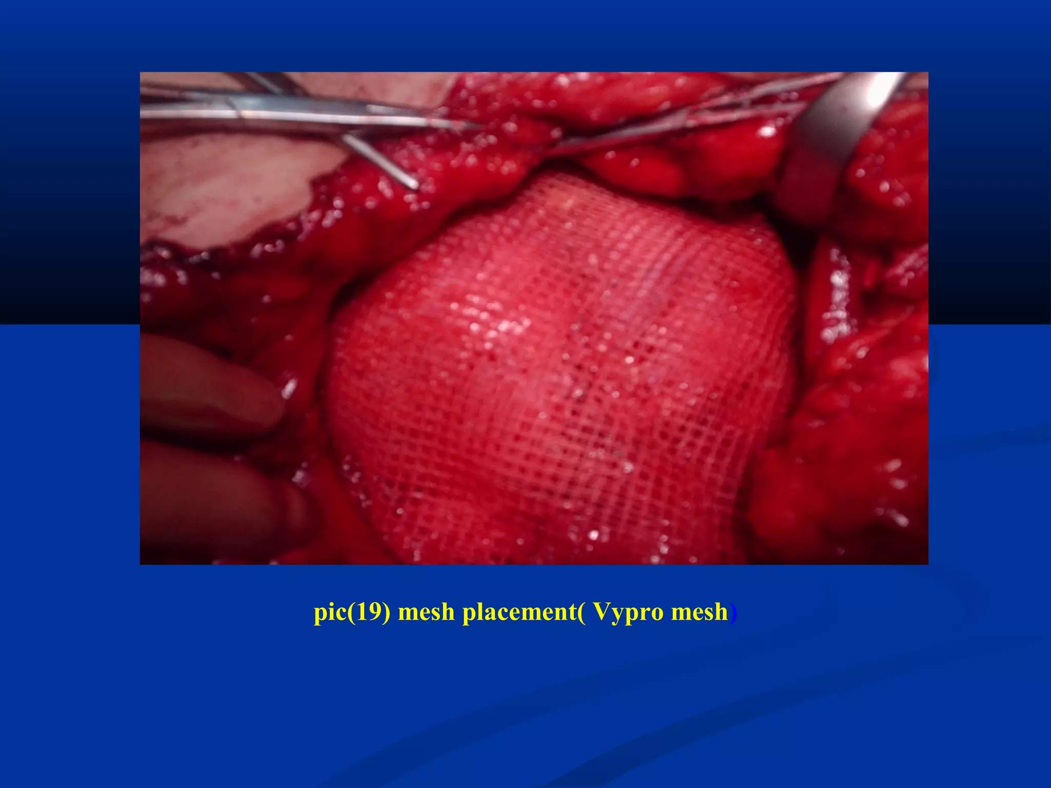 pic(19) mesh placement( Vypro mesh)
 