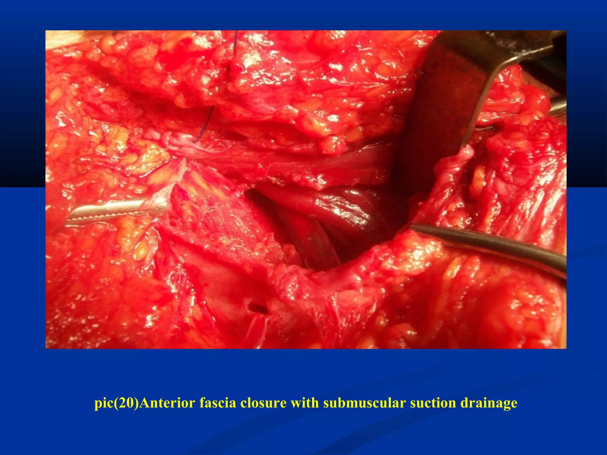pic(20)Anterior fascia closure with submuscular suction drainage
 