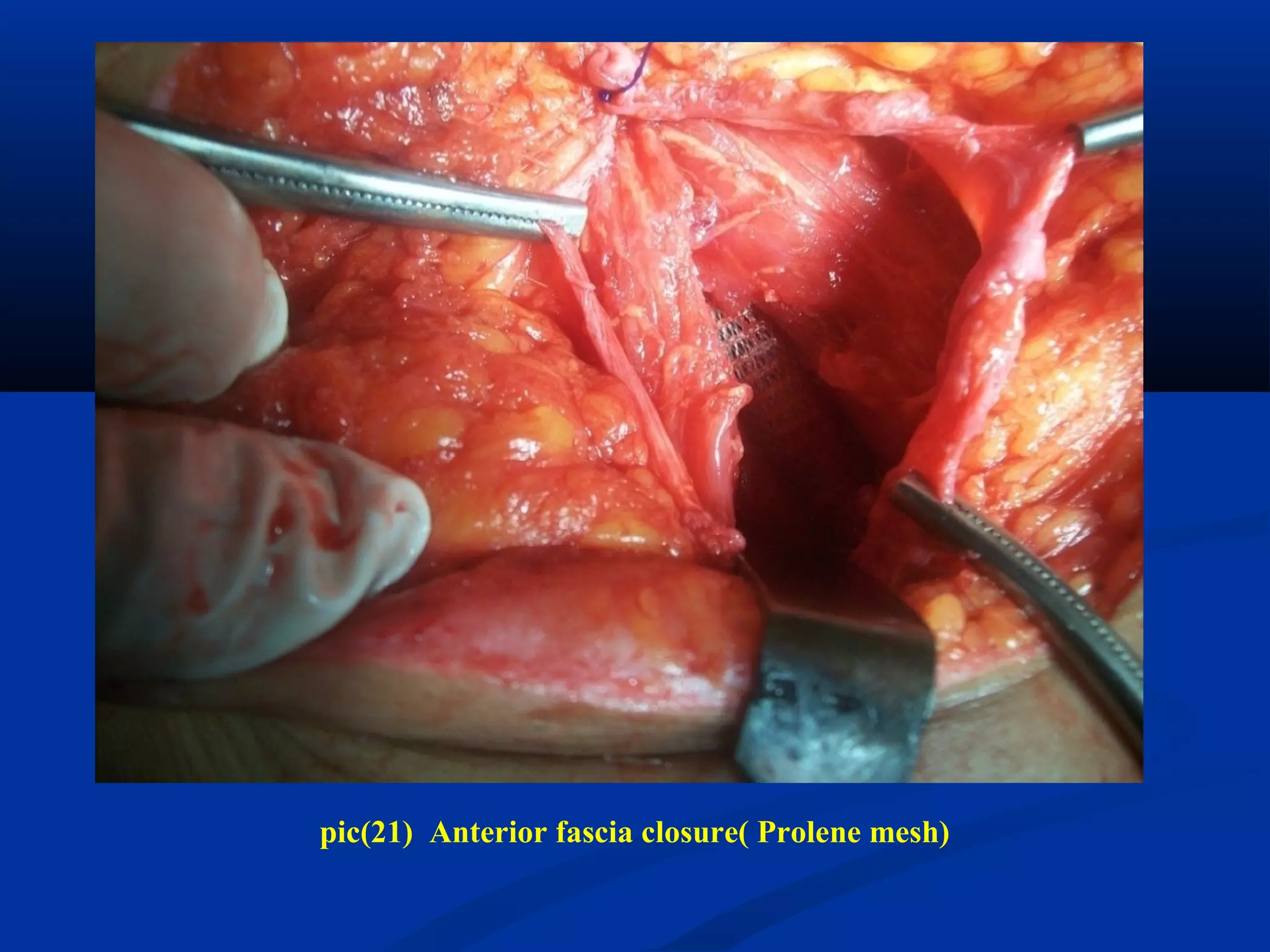 pic(21) Anterior fascia closure( Prolene mesh)
 