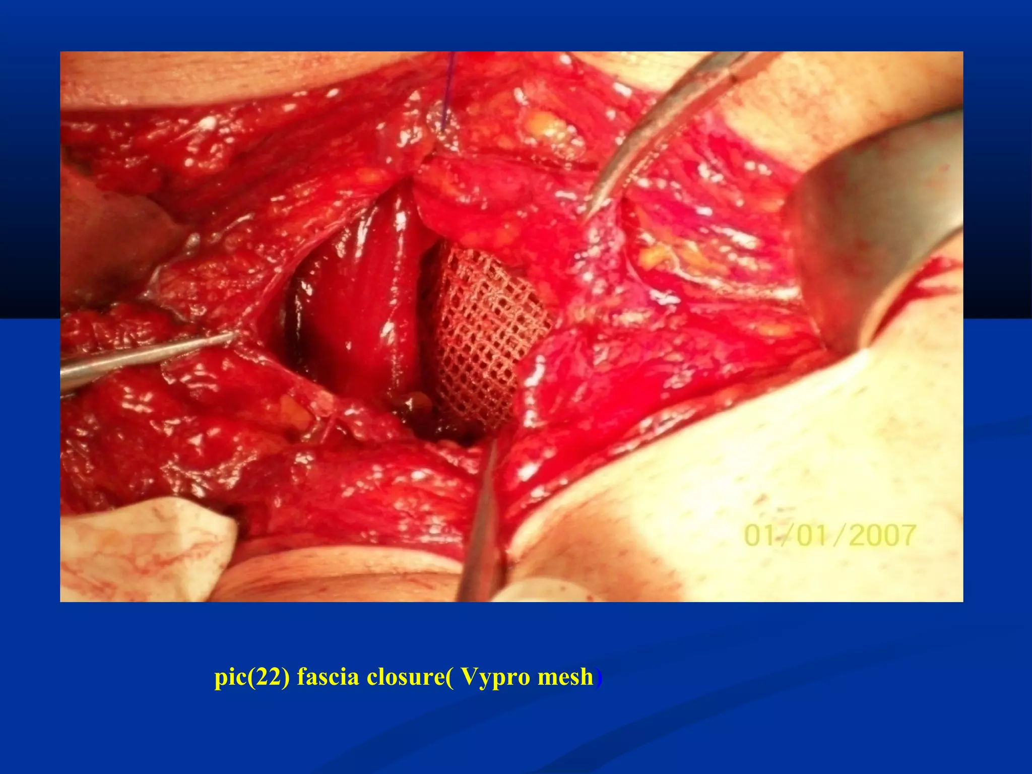 pic(22) fascia closure( Vypro mesh)
 