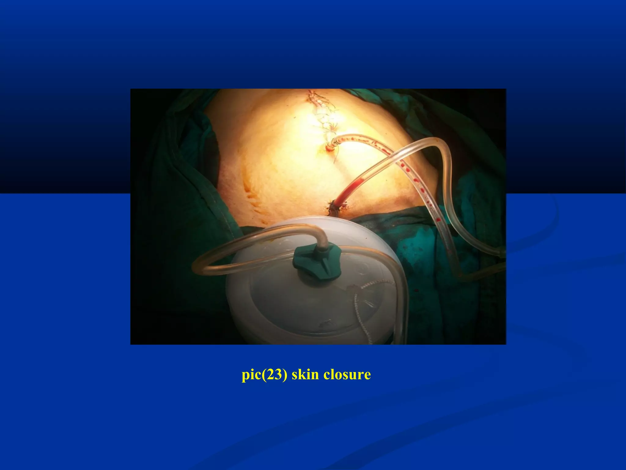 pic(23) skin closure
 