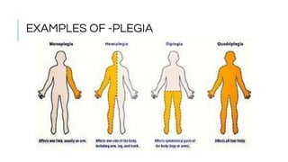 EXAMPLES OF -PLEGIA
 