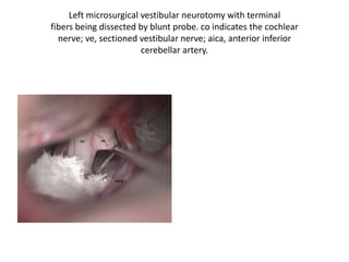 The posterior inferior cerebellar artery travels
through the nerve fiber roots of the accessory
nerve and
encircles the br...