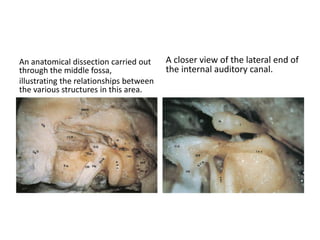 Photograph of a cadaveric dissection showing an overview of the temporal bone and depicting the posterior
surface of the p...