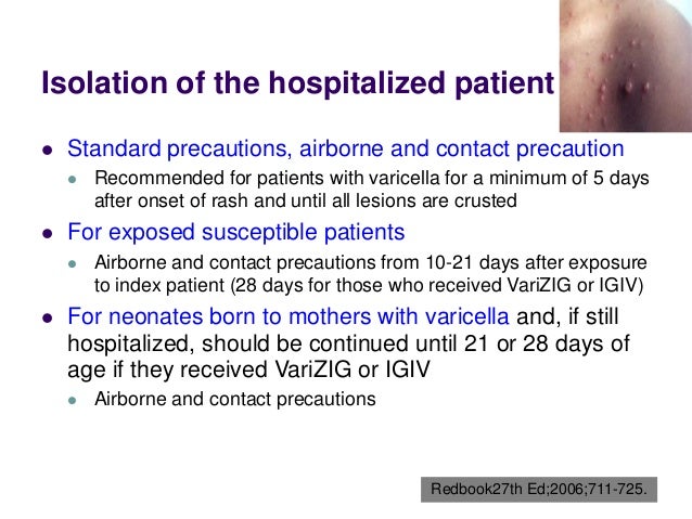 Varicella zoster virus