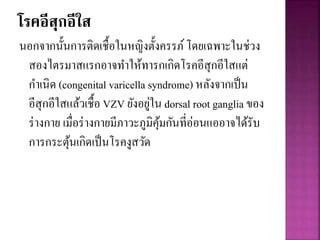 โรคอีสุกอีใส
นอกจากนั้นการติดเชื้อในหญิงตั้งครรภ์โดยเฉพาะในช่วง
สองไตรมาสแรกอาจทาให้ทารกเกิดโรคอีสุกอีใสแต่
กาเนิด (congenital varicella syndrome) หลังจากเป็น
อีสุกอีใสแล้วเชื้อ VZV ยังอยู่ใน dorsal root ganglia ของ
ร่างกาย เมื่อร่างกายมีภาวะภูมิคุ้มกันที่อ่อนแออาจได้รับ
การกระตุ้นเกิดเป็นโรคงูสวัด
 