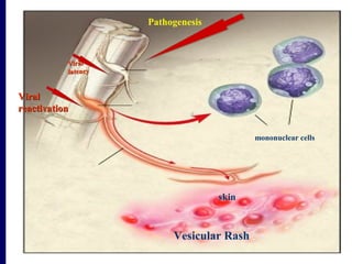 ViralViral
reactivationreactivation
Vesicular Rash
Pathogenesis
ViralViral
latencylatency
mononuclear cells
skin
 