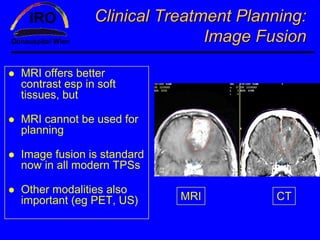 Clinical Treatment Planning:
                              Image Fusion

MRI offers better
contrast esp in soft
tissues, but

MRI cannot be used for
planning

Image fusion is standard
now in all modern TPSs

Other modalities also
important (eg PET, US)     MRI        CT
 