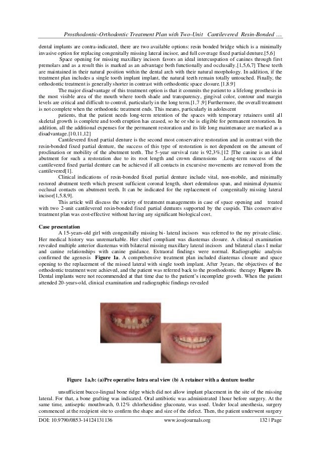 ProsthodonticOrthodontic Treatment Plan with TwoUnit Cantilevered R…