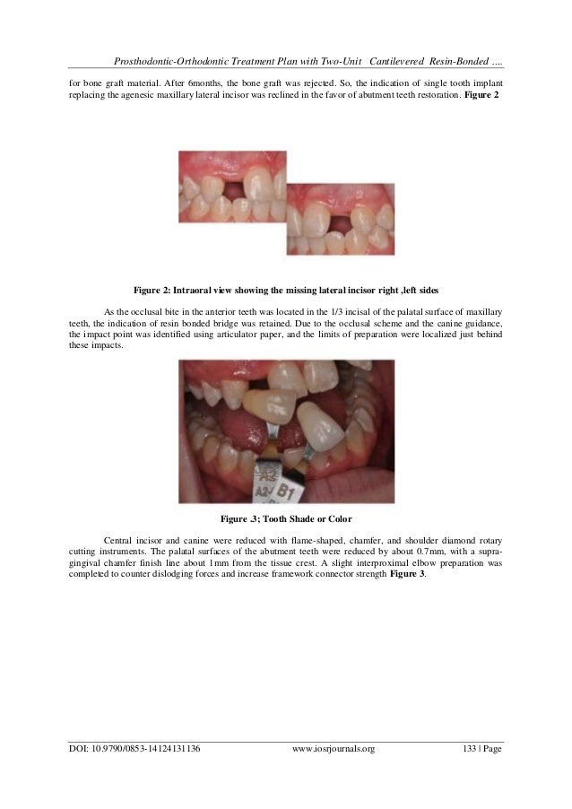 ProsthodonticOrthodontic Treatment Plan with TwoUnit Cantilevered R…