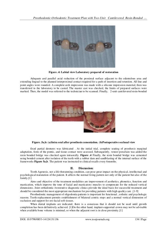 ProsthodonticOrthodontic Treatment Plan with TwoUnit Cantilevered R…