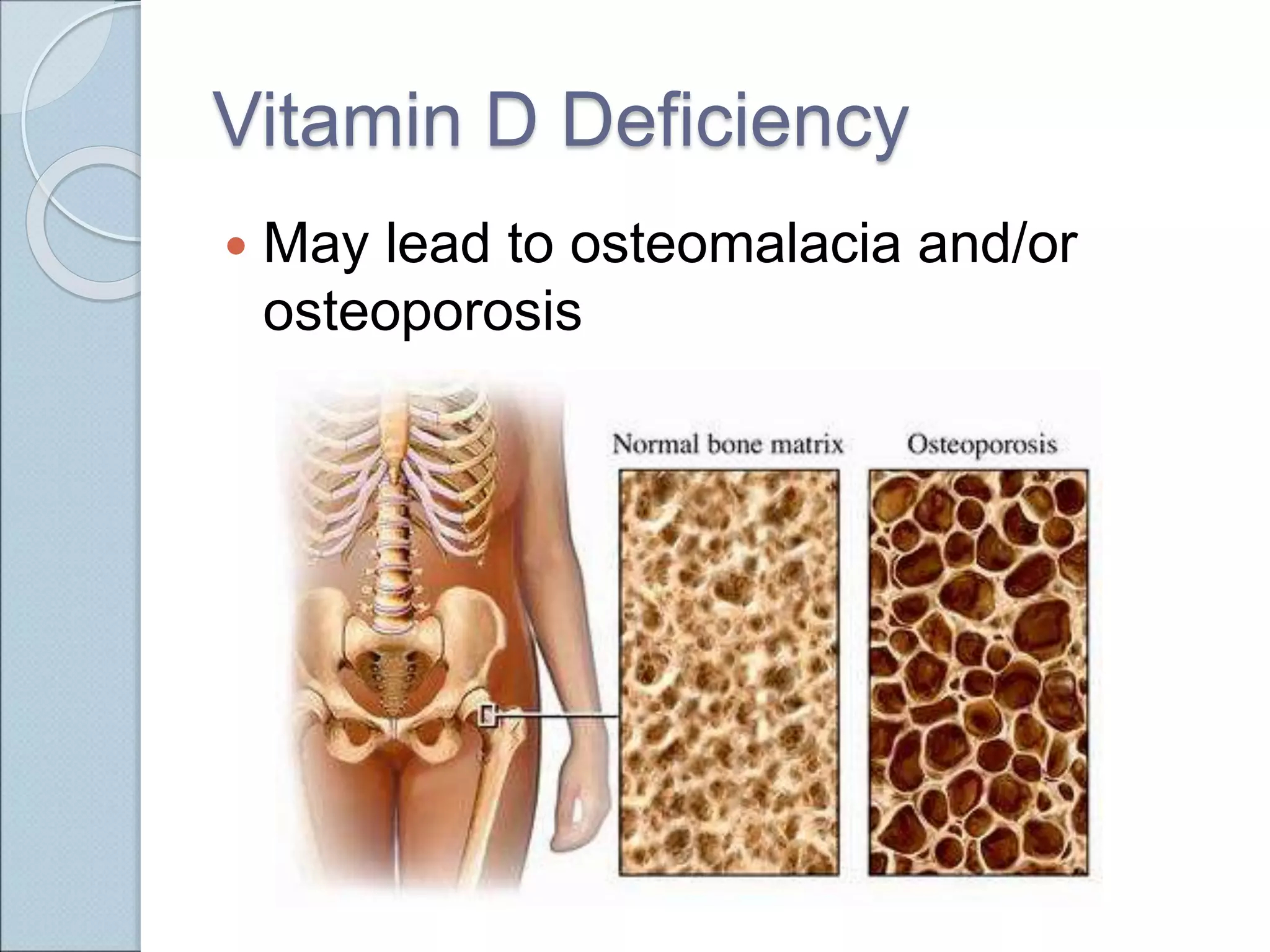 Vitamin D Deficiency
 May lead to osteomalacia and/or
osteoporosis
 