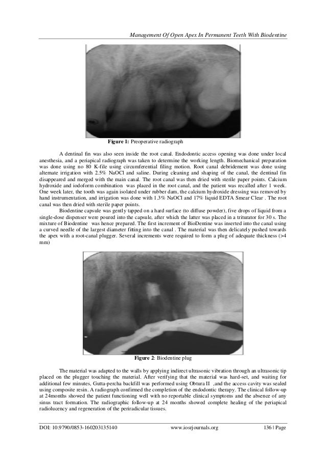 Management of Open Apex in Permanent Teeth with Biodentine