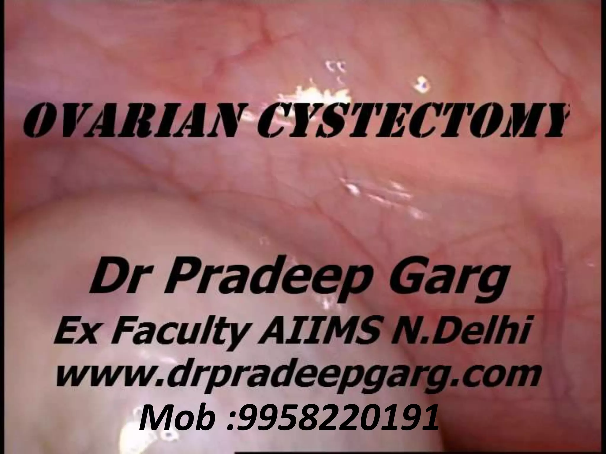 Laparoscopic Ovarian Cystectomy Cpt Codes: What Every Doctor Needs To Know - jal3emc