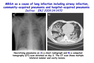 MRSA as a cause of lung infection including airway infection, community-acquired pneumonia and hospital-acquired pneumonia  Defres   ERJ 2009:34:1470  Necrotising pneumonia on  A ) a chest radiograph and  B ) a computed tomography (CT) scan obtained on day 3. The CT scan shows multiple bilateral nodular and cavity lesions.  