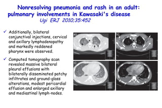 Nonresolving pneumonia and rash in an adult: pulmonary involvements in Kawasaki's disease   Ugi  ERJ  2010;35:452  Additionally, bilateral conjunctival injections, cervical and axillary lymphadenopathy and markedly reddened pharynx were observed.  Computed tomography scan revealed massive bilateral pleural effusions with bilaterally disseminated patchy infiltrates and ground-glass alterations, modest pericardial effusion and enlarged axillary and mediastinal lymph-nodes.  
