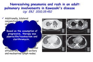 Nonresolving pneumonia and rash in an adult: pulmonary involvements in Kawasaki's disease   Ugi  ERJ  2010;35:452  Additionally, bilateral conjunctival injections, cervical and axillary lymphadenopathy and markedly reddened pharynx were observed.  Computed tomography scan revealed massive bilateral pleural effusions with bilaterally disseminated patchy infiltrates and ground-glass alterations, modest pericardial effusion and enlarged axillary and mediastinal lymph-nodes.  Based on the assumption of progressive, therapy was piperacillin/tazobactam and clarithromycin.  