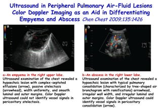 a-An empyema   in the right upper lobe.  Ultrasound examination of the chest revealed a hypoechoic lesion with complex-septated effusions (arrow), passive atelectasis (arrowhead), width uniformity, and smooth luminal and outer margins. Color Doppler ultrasound could not identify vessel signals in pericavitary atelectasis. b-An abscess   in the  right lower lobe.  Ultrasound examination of the chest revealed a hypoechoic lesion with typical pulmonary consolidation (characterized by tree-shaped air bronchogram with ramifications) arrowhead, irregular wall width, and irregular luminal and outer margins. Color Doppler ultrasound could identify  vessel signals in pericavitary consolidation (arrow). Ultrasound in Peripheral Pulmonary Air-Fluid Lesions Color Doppler Imaging as an Aid in Differentiating Empyema and Abscess  Chen Chest 2009;135:1426 