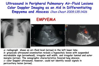 a:  radiograph  shows an air-fluid level (arrow) in the left lower lobe.  b:  grayscale ultrasound examination reveals a hypoechoic lesion with suspended microbubble sign (arrowhead), irregular wall width, and irregular luminal and outer margins (arrow). The sonographic characteristics favored lung abscess.  c:  color Doppler ultrasound, however, could not identify vessel signals in pericavitary lesion (arrow). EMPYEMA Ultrasound in Peripheral Pulmonary Air-Fluid Lesions Color Doppler Imaging as an Aid in Differentiating Empyema and Abscess  Chen Chest 2009;135:1426 