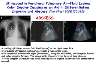 d : radiograph shows an air-fluid level (arrow) in the right lower lobe.  e:  grayscale ultrasound examination reveals a hypoechoic lesion with suspended microbubble signs (arrowhead), irregular wall width, and irregular luminal and outer margins (arrow). The sonographic characteristics favored lung abscess.  f:  color Doppler ultrasound also could identify vessel signals in pericavitary consolidation (arrow). ABSCESS Ultrasound in Peripheral Pulmonary Air-Fluid Lesions Color Doppler Imaging as an Aid in Differentiating Empyema and Abscess  Chen Chest 2009;135:1426 