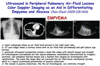 a:  chest radiograph shows an air-fluid level (arrow) in the right lower lobe.  b: CT scan image shows a  cavitary lesion with an air-fluid level (arrowhead) and split pleura sign (arrow).  c: grayscale ultrasound examination reveals a band-like shape with smooth margin and straight air-bronchograms (arrowhead) not like typical pulmonary consolidation characterized by irregular, serrated, and somewhat blurred margin and a marked tree-shaped air bronchogram with ramifications. The band-like shape does not surround the air-fluid lesion continuously (arrow), which is a typical (continued) presentation of passive atelectasis.  d: the vessels in passive  atelectasis, like the air bronchogram, are relatively straight. Ultrasound in Peripheral Pulmonary Air-Fluid Lesions Color Doppler Imaging as an Aid in Differentiating Empyema and Abscess  Chen Chest 2009;135:1426 EMPYEMA 