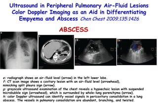 e:  radiograph shows an air-fluid level (arrow) in the left lower lobe.  f:  CT scan image shows a cavitary lesion with an air-fluid level (arrowhead), mimicking split pleura sign (arrow).  g:  grayscale ultrasound examination of the chest reveals a hypoechoic lesion with suspended microbubble sign (arrowhead), which is surrounded by whole-lung parenchyma (arrow).  h:  color Doppler ultrasound can identify vessel signals in pericavitary consolidation in a lung abscess. The vessels in pulmonary consolidation are  abundant, branching, and twisted. Ultrasound in Peripheral Pulmonary Air-Fluid Lesions Color Doppler Imaging as an Aid in Differentiating Empyema and Abscess  Chen Chest 2009;135:1426 ABSCESS 