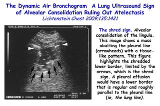 The shred sign.  Alveolar consolidation of the lingula. This image shows a mass abutting the pleural line (arrowheads) with a tissue-like pattern. This figure highlights the shredded lower border, limited by the arrows, which is the shred sign. A pleural effusion would have a lower border that is regular and roughly parallel to the pleural line ( ie, the lung line). The Dynamic Air Bronchogram  A Lung Ultrasound Sign of Alveolar Consolidation  Ruling Out Atelectasis Lichtenstein Chest 2009;135:1421 