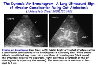 Dynamic air bronchogram  (real time).  Left : tubular bright artifactual structures within a consolidation corresponding to air bronchograms in expiratory time. White arrows indicate consolidated lung tissue. Note punctiform air bronchograms (black arrow).  The arrowhead indicates the diaphragm.  Right : centrifugal progression of the air bronchograms in inspiratory time (arrows). The excursion can be measured at least equal to 1 cm. The Dynamic Air Bronchogram  A Lung Ultrasound Sign of Alveolar Consolidation  Ruling Out Atelectasis Lichtenstein Chest 2009;135:1421 expire inspire 