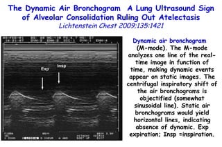 Dynamic air bronchogram   (M-mode). The M-mode analyzes one line of the real-time image in function of time, making dynamic events appear on static images. The centrifugal inspiratory shift of the air bronchograms is objectified (somewhat sinusoidal line). Static air bronchograms would yield horizontal lines, indicating absence of dynamic. Exp expiration;  Insp =inspiration. The Dynamic Air Bronchogram  A Lung Ultrasound Sign of Alveolar Consolidation  Ruling Out Atelectasis Lichtenstein Chest 2009;135:1421 