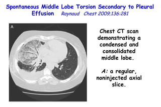 Spontaneous Middle Lobe Torsion Secondary to Pleural Effusion  Raynaud  Chest 2009;136:281 Chest CT scan demonstrating a condensed and consolidated middle lobe.  A:  a regular, noninjected axial slice. 