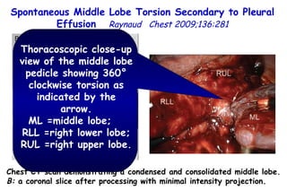 Spontaneous Middle Lobe Torsion Secondary to Pleural Effusion  Raynaud  Chest 2009;136:281 Chest CT scan demonstrating a condensed and  consolidated middle lobe. B:  a coronal slice after processing with minimal intensity projection. Thoracoscopic close-up view of the middle lobe pedicle showing 360° clockwise torsion as indicated by the arrow. ML =middle lobe;  RLL =right lower lobe; RUL =right upper l obe. 