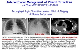 Serial chest radiographs and CT scan images demonstrating  rapid progression of infected pleural fluid to an empyema  that required surgical drainage.  A: a chest radiograph obtained at hospital admission demonstrates a right pleural effusion and parenchymal  density at the right lung base. Therapy with antibiotics was begun, but thoracentesis was not performed. The effusion became massive 3 days later ( B) when a noncontrasted CT scan (C) demonstrated multiple locules that contained viscous pus during surgical drainage.  Without contrast, the CT scan could not clearly differentiate in some areas between loculated fluid and lung consolidation. Pathophysiologic Classification and Clinical Staging of Pleural Infections Interventional Management of Pleural Infections  Heffner CHEST 2009; 136:1148 admission 3 days later 3 days later 