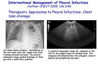( A) shows dense airspace  consolidation in the left lower lobe and  lingula with fluid tracking laterally (arrows). The patient underwent image-guided drainage of thick pus with a small-bore catheter. A sagittal sonographic image ( B, cephalad to the left of the image) shows  no residual fluid. The sonogram ( B) demonstrates the echogenic visceral pleural line peripherally  (arrows). Interventional Management of Pleural Infections  Heffner CHEST 2009; 136:1148 Therapeutic Approaches to Pleural Infections:  Chest tube drainage . 
