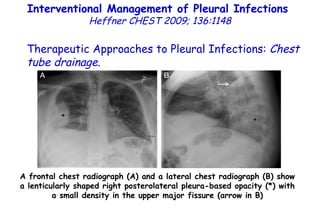 A frontal chest radiograph (A) and a lateral chest radiograph (B) show a lenticularly shaped right posterolateral pleura-based opacity (*) with a small density in the upper major fissure (arrow in B) Interventional Management of Pleural Infections  Heffner CHEST 2009; 136:1148 Therapeutic Approaches to Pleural Infections:  Chest tube drainage . 