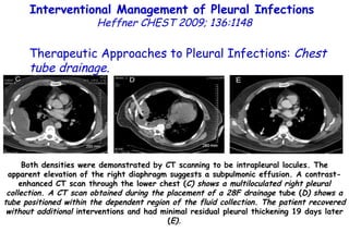 Both densities were demonstrated by CT scanning to be intrapleural locules. The apparent elevation of the right diaphragm suggests a subpulmonic effusion. A contrast-enhanced CT scan through the lower chest ( C) shows a multiloculated right pleural collection. A CT scan obtained during the placement of a 28F drainage  tube ( D) shows a tube positioned within the dependent region of the fluid collection. The patient recovered without additional  interventions and had minimal residual pleural thickening 19 days later ( E). Interventional Management of Pleural Infections  Heffner CHEST 2009; 136:1148 Therapeutic Approaches to Pleural Infections:  Chest tube drainage . 