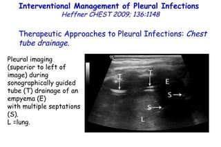 Pleural imaging (superior to left of image) during sonographically guided tube (T) drainage of an empyema (E) with multiple septations (S).  L =lung. Interventional Management of Pleural Infections  Heffner CHEST 2009; 136:1148 Therapeutic Approaches to Pleural Infections:  Chest tube drainage . 