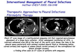 Chest CT scan image of a multiloculated empyema ( A) that required percutaneous  placement of a large-bore catheter. After subsequent instillation of rtPA, a contrast-enhanced scan ( B)  at the level of the aortic arch shows the tube in the pleural space posteriorly with minimal residual pleural fluid or thickening (white curved arrows) and regions of edema (black curved arrows) of the extrapleural fat (black straight arrows),  a finding often seen on CT scans of patients with empyema. Interventional Management of Pleural Infections  Heffner CHEST 2009; 136:1148 Therapeutic Approaches to Pleural Infections:  Fibrinolytic Therapy . 