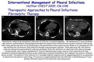 Hemothorax complicating intrapleural instillation of rtPA for a loculated empyema.  An unenhanced CT scan ( A) shows right  anterior, posterolateral, and paraspinal and small left pleural fluid collections with a pigtail catheter entering the right chest wall (arrow) with its tip terminating in the posterolateral fluid collection (not shown in  A). Intrapleural rtPA was instilled into the anterior fluid  collection through a second pigtail catheter. Three days later ( B), the anterior collection drained but posterolateral collection persisted.  After the instillation of additional rtPA, pleural drainage became bloody, and a repeat unenhanced CT scan ( C) demonstrated a large,  anterior fluid collection with high-attenuation material dependently (black arrow) reflecting a loculated hemothorax that displaced the anterior catheter (white arrows). The posterior fluid collection in  C increased slightly compared with B, suggesting posterior accumulation  of blood from the anterior hemorrhage. This series of images demonstrates the difficulty in establishing by CT scan whether different pleural fluid collections intercommunicate Interventional Management of Pleural Infections  Heffner CHEST 2009; 136:1148 Therapeutic Approaches to Pleural Infections:  Fibrinolytic Therapy . 